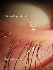 Blefarite